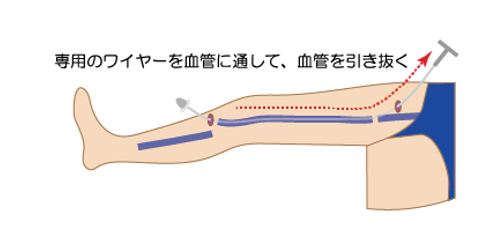 外科的手術（ストリッピング手術）