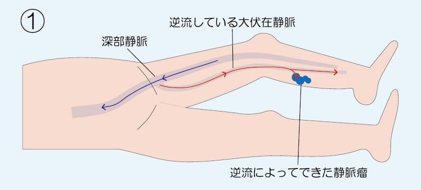 血管内塞栓術（グルー治療、瞬間接着剤）｜東京都台東区で下肢