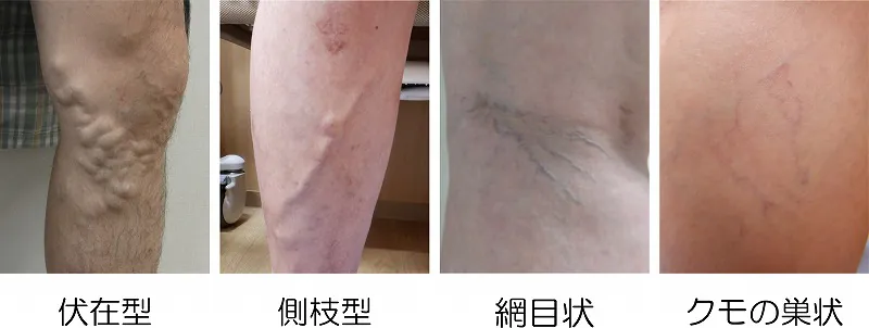 下肢静脈瘤のタイプ