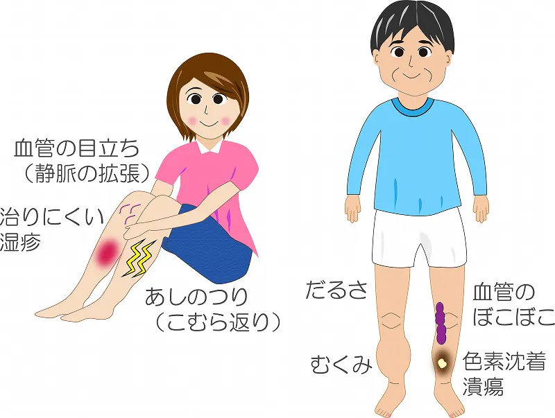 下肢静脈瘤とは
